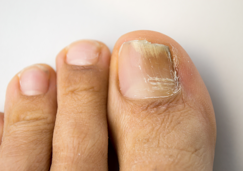 fungal nails, fungal nails podiatrist, fungal nails treatment melbourne, hazel rauch, podiatrist parkdale, podiatrist bayside, podiatrist kingston, Hazel podiatrist, podiatry parkdale