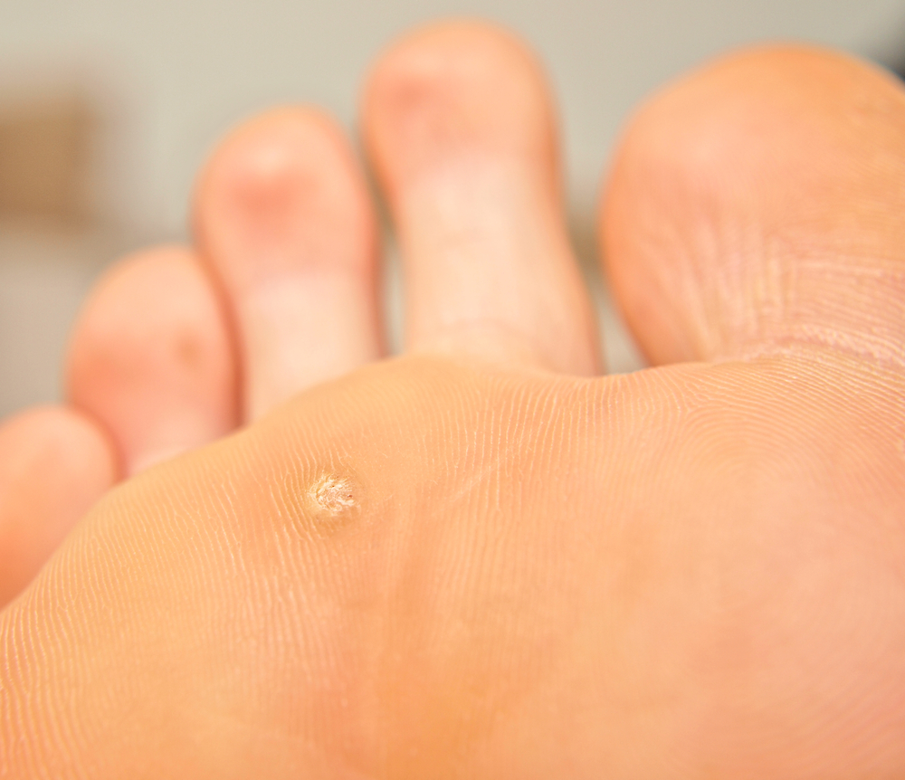 warts, papillomas, warts podiatry, warts podiatrist melbourne, hazel rauch, podiatrist parkdale, podiatrist bayside, podiatrist kingston, Hazel podiatrist, podiatry parkdale